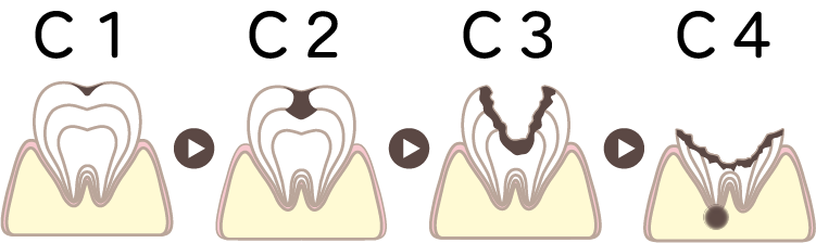 虫歯の進行と治療法